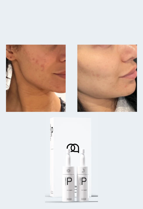 Prescription Medical Grade Skincare Treatment For Clear Complexion