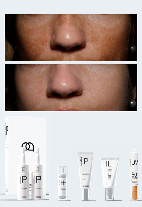 Personalised Medical Grade Prescription Skincare Treatment for pigmentation complete package