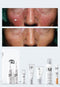 Personalised Medical Grade Prescription Skincare Treatment for Rosacea complete package