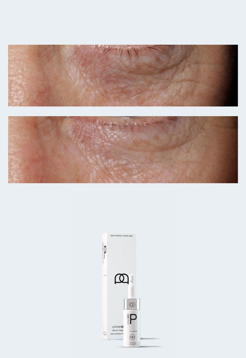 Prescription Medical Grade Under-eye Pigmentation, Wrinkles & Fine Lines Eye Serum Treatment