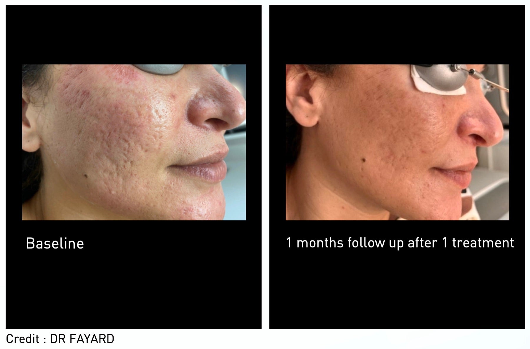 Origin Glass Laser acne scarring before and after 1 month follow-up after 1 treatment.