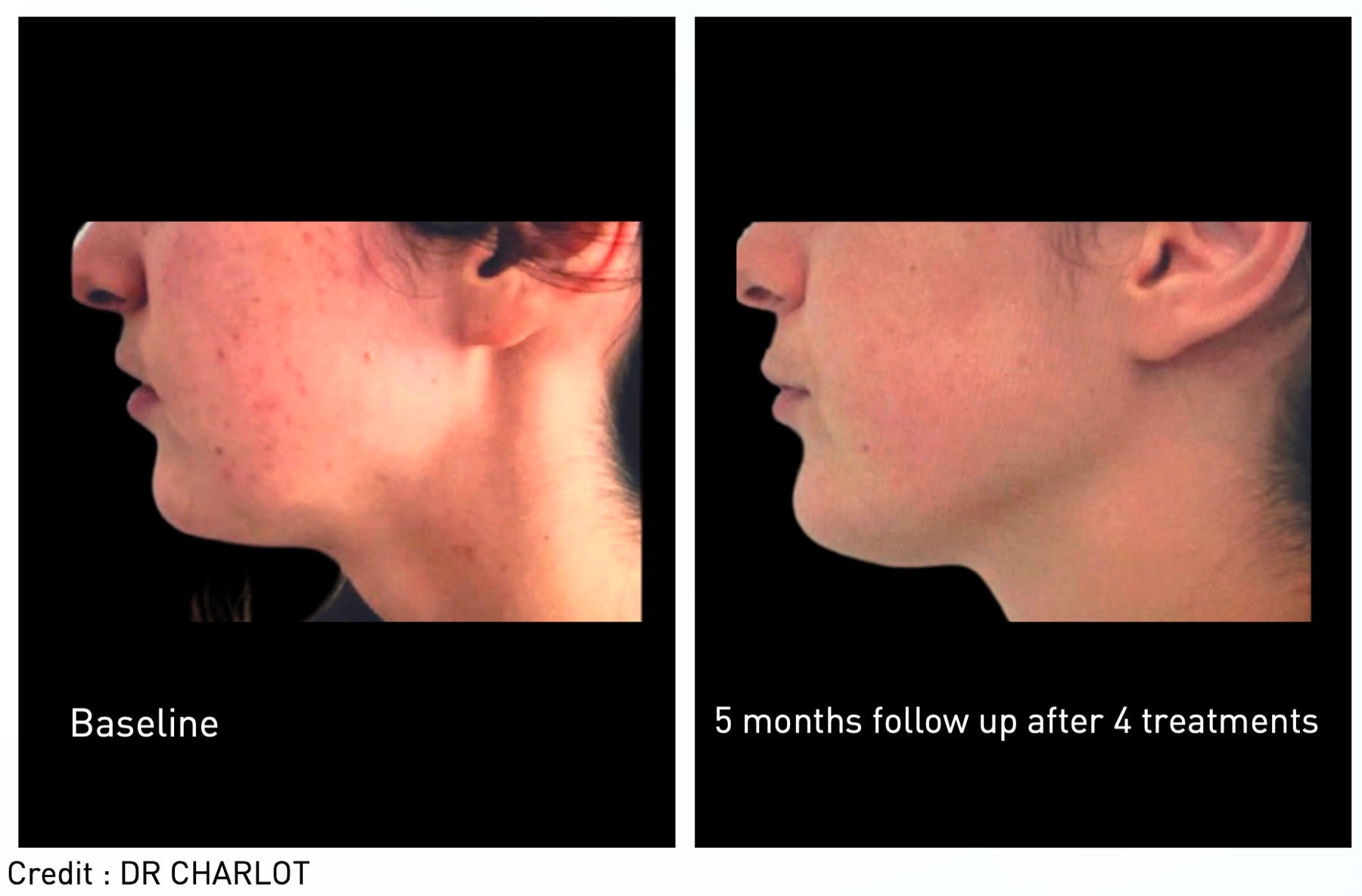 Origin Glass Laser inflammatory acne before and after 1 month follow-up after assessment-led treatment.