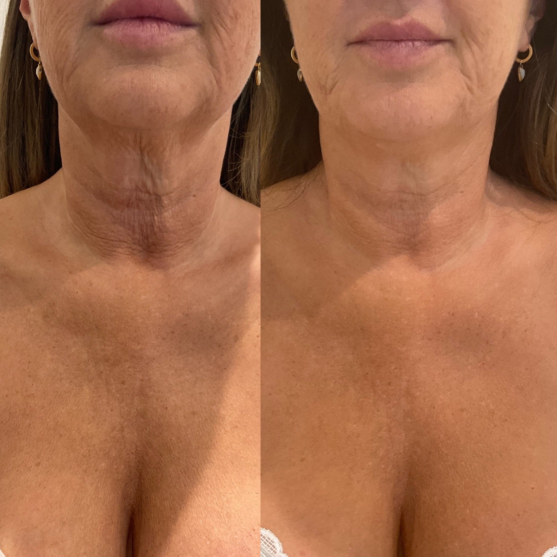 Origin Glass Laser neck and decollete skin tightening before and after result.