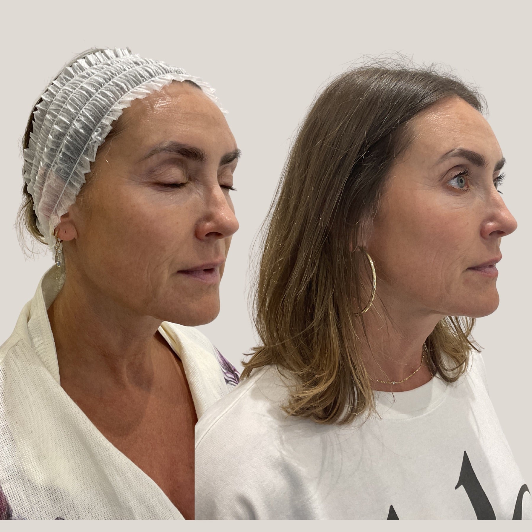 Origin Glass Laser Day 19 result comparison image two showing early rejuvenation.