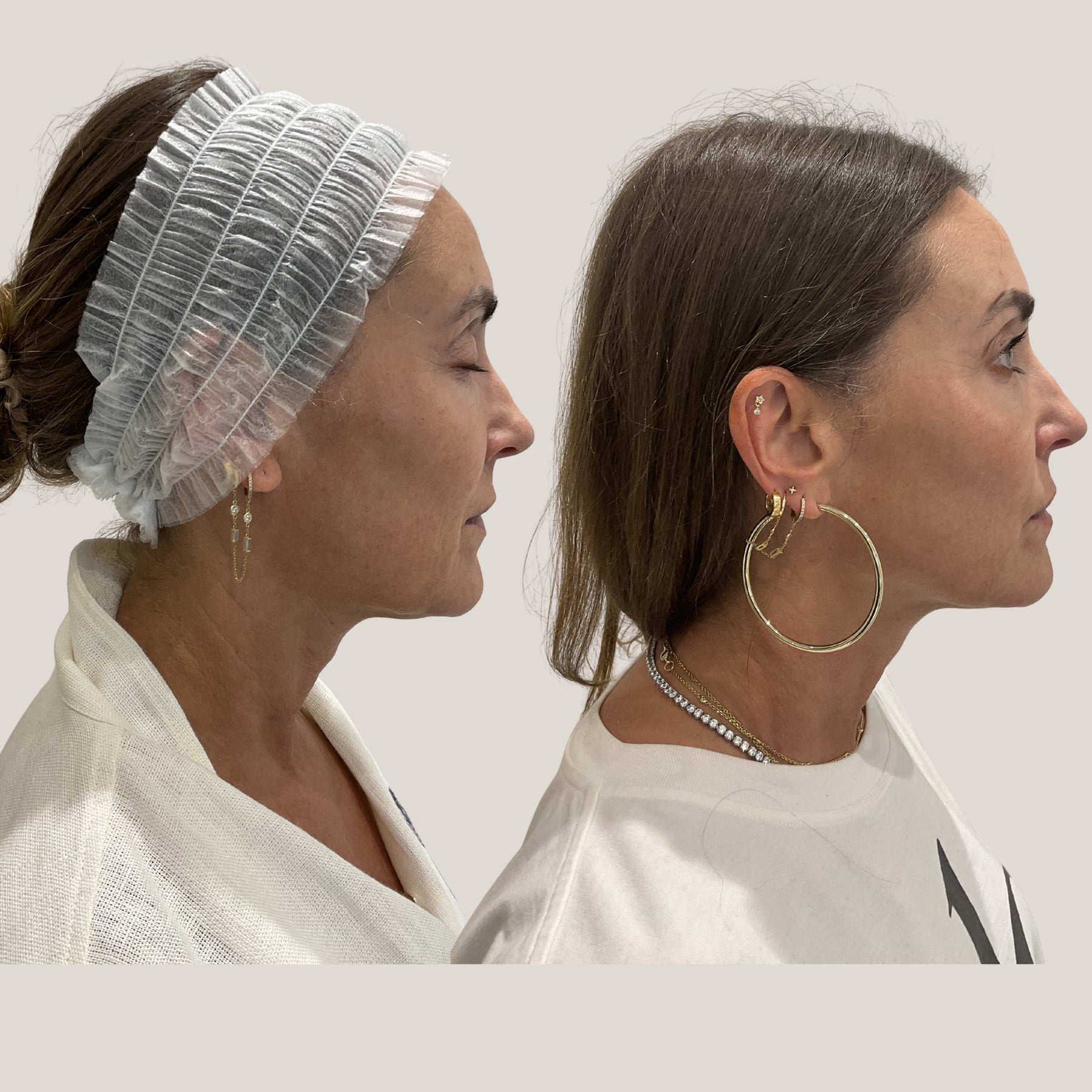 Origin Glass Laser Day 19 result comparison image three showing skin-quality refinement.