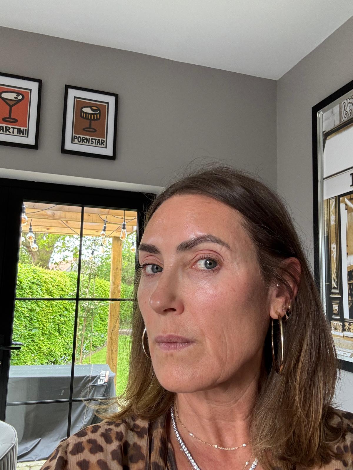 Origin Glass Laser Treatment 1 Day 2 recovery still image three after full-face treatment.