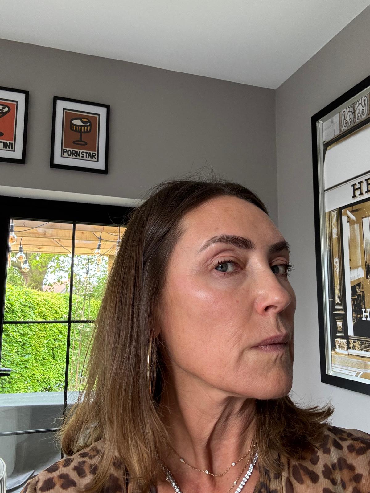 Origin Glass Laser Treatment 1 Day 2 recovery still image five after full-face treatment.