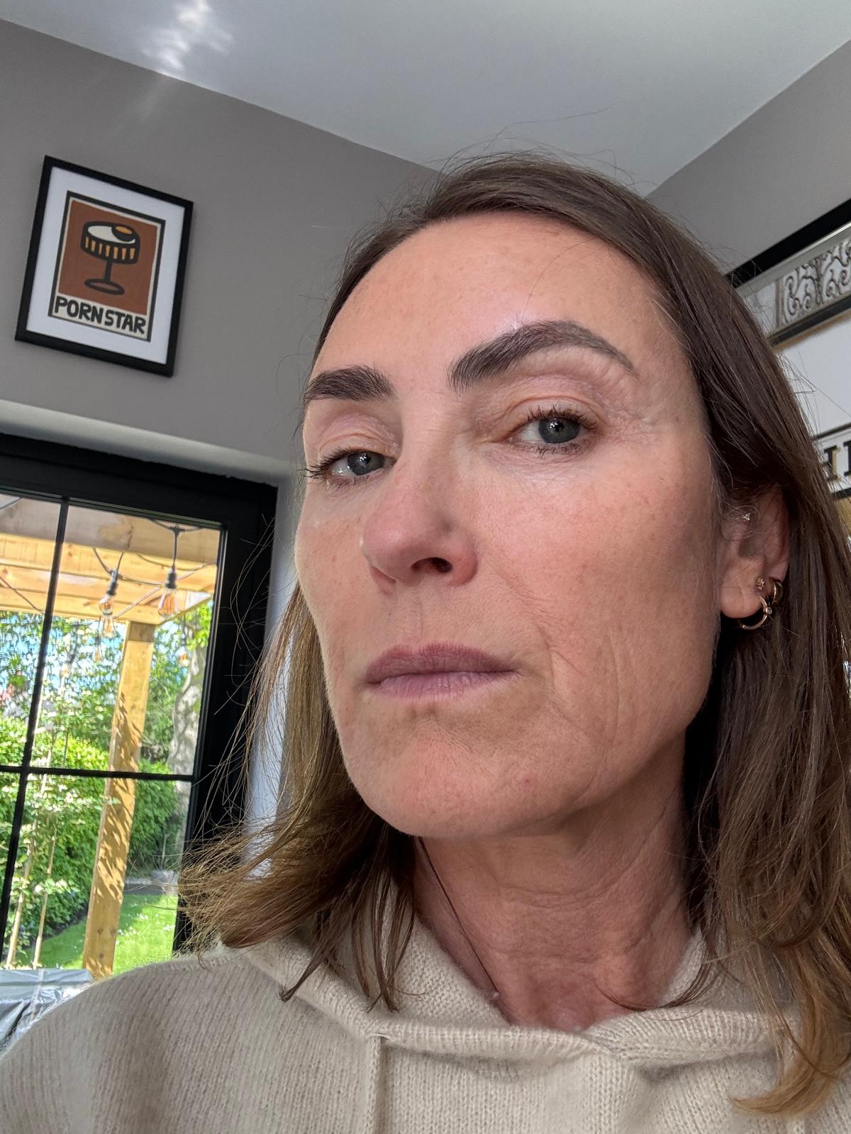 Origin Glass Laser Treatment 1 Day 3 recovery still image one after full-face treatment.
