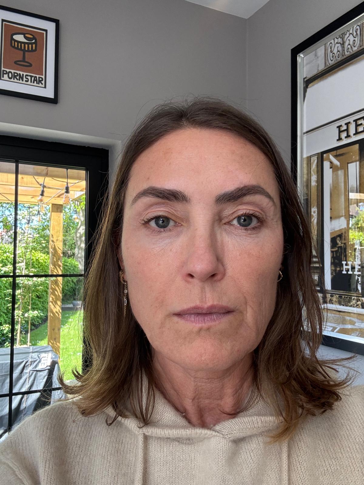 Origin Glass Laser Treatment 1 Day 3 recovery still image two after full-face treatment.