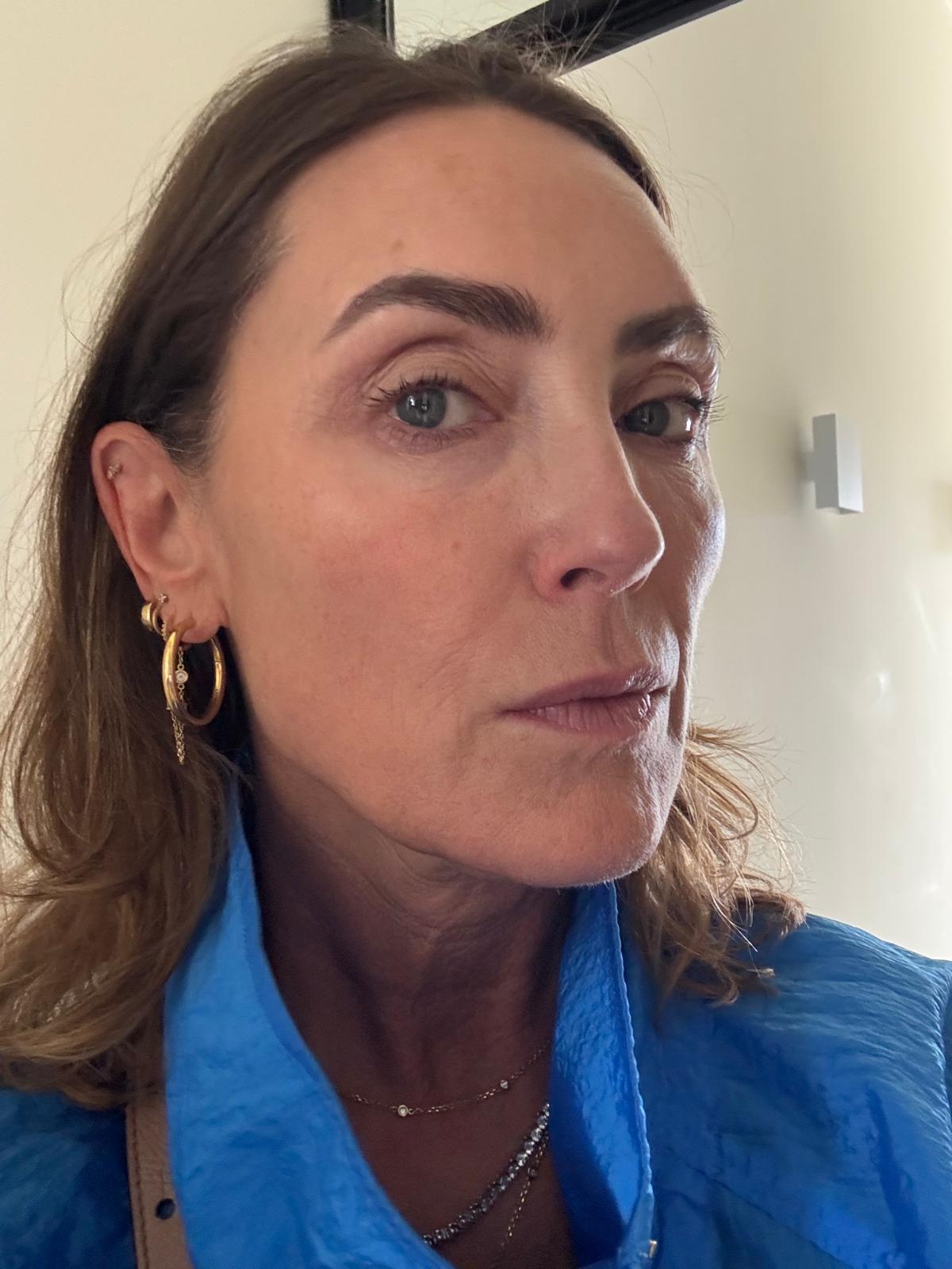 Origin Glass Laser Treatment 1 Day 4 recovery still image one after full-face treatment.