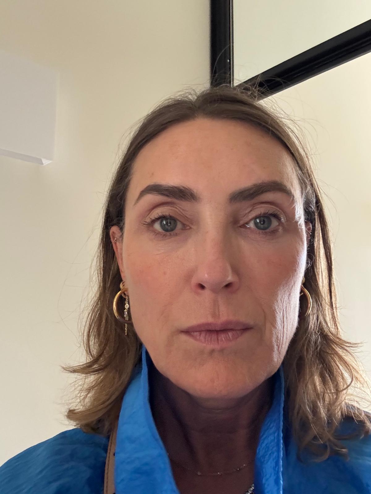 Origin Glass Laser Treatment 1 Day 4 recovery still image two after full-face treatment.