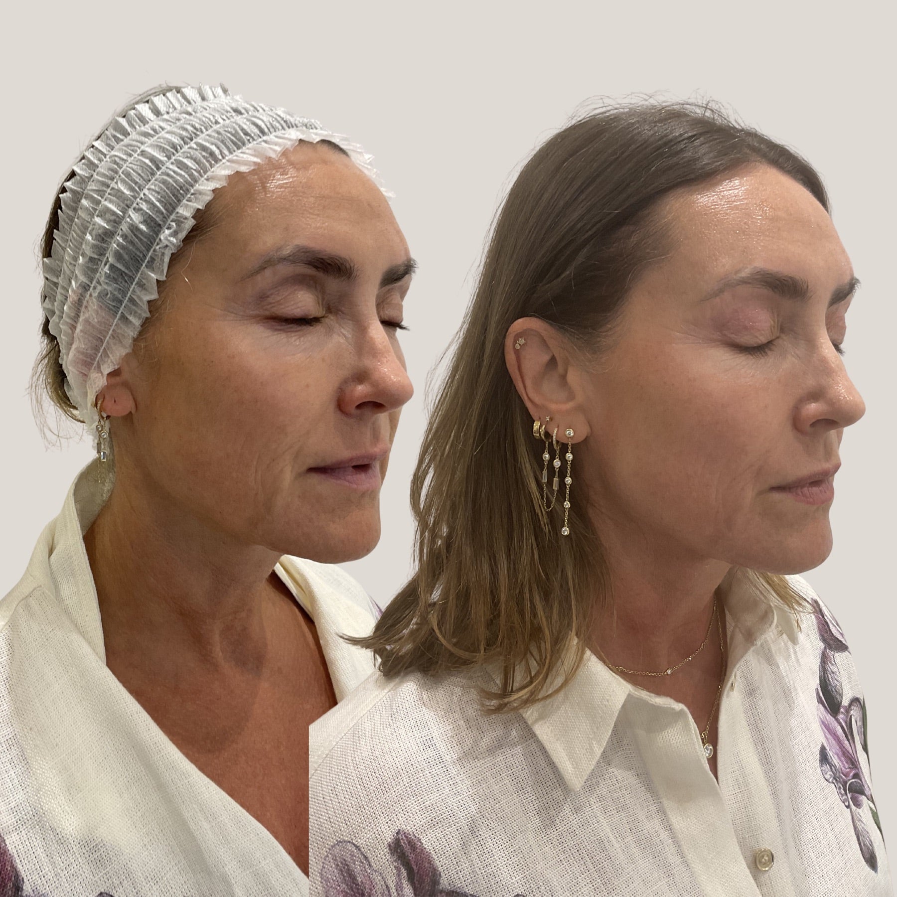 Origin Glass Laser 2 hours post-treatment visible freshness comparison, result image two.