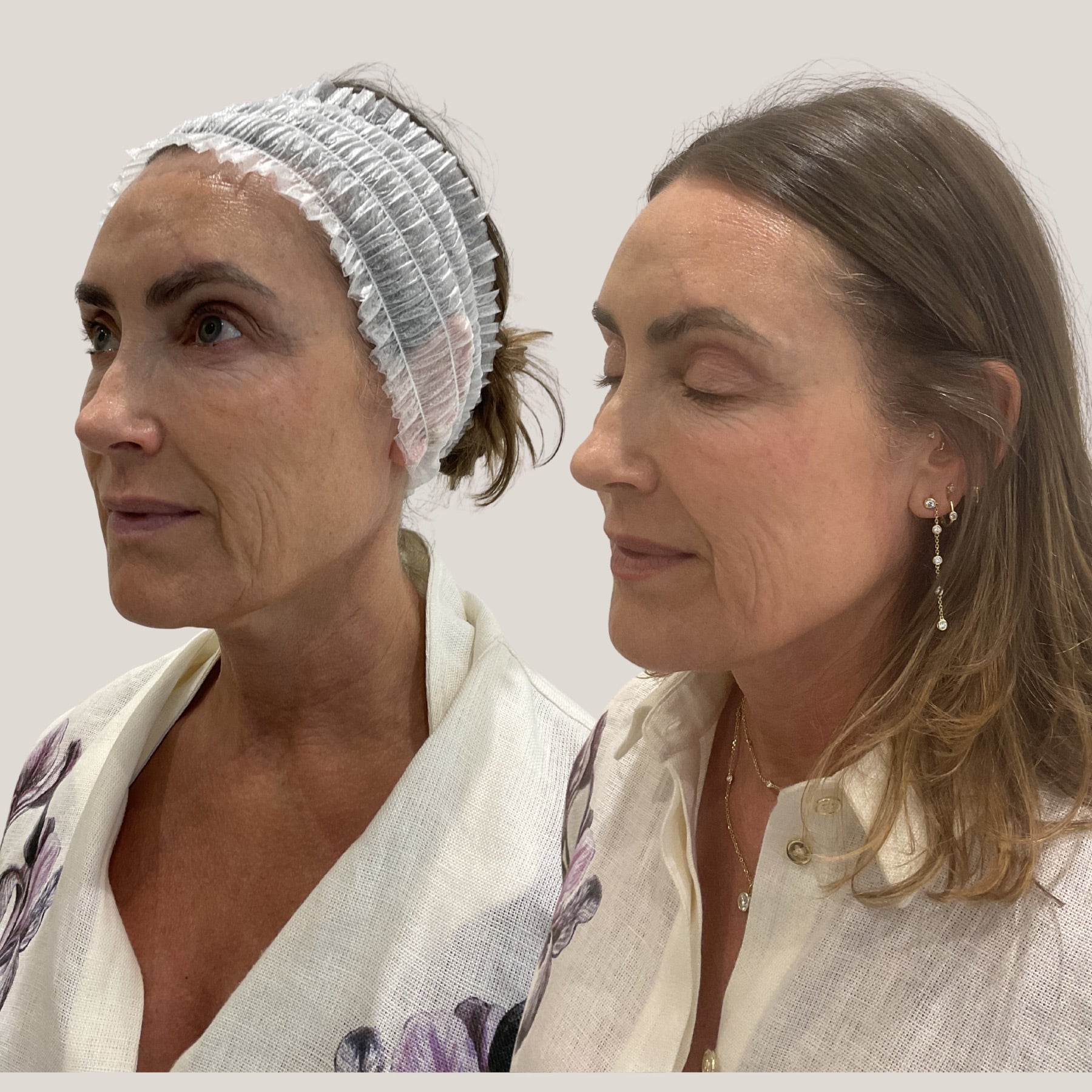 Origin Glass Laser 2 hours post-treatment visible freshness comparison, result image four.