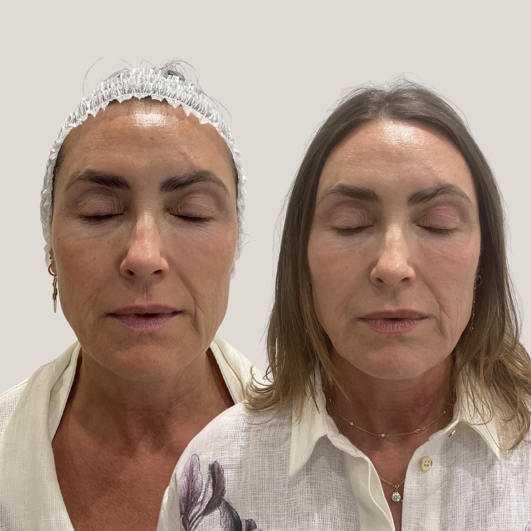 Origin Glass Laser 2 hours post-treatment visible freshness comparison, full result image one.