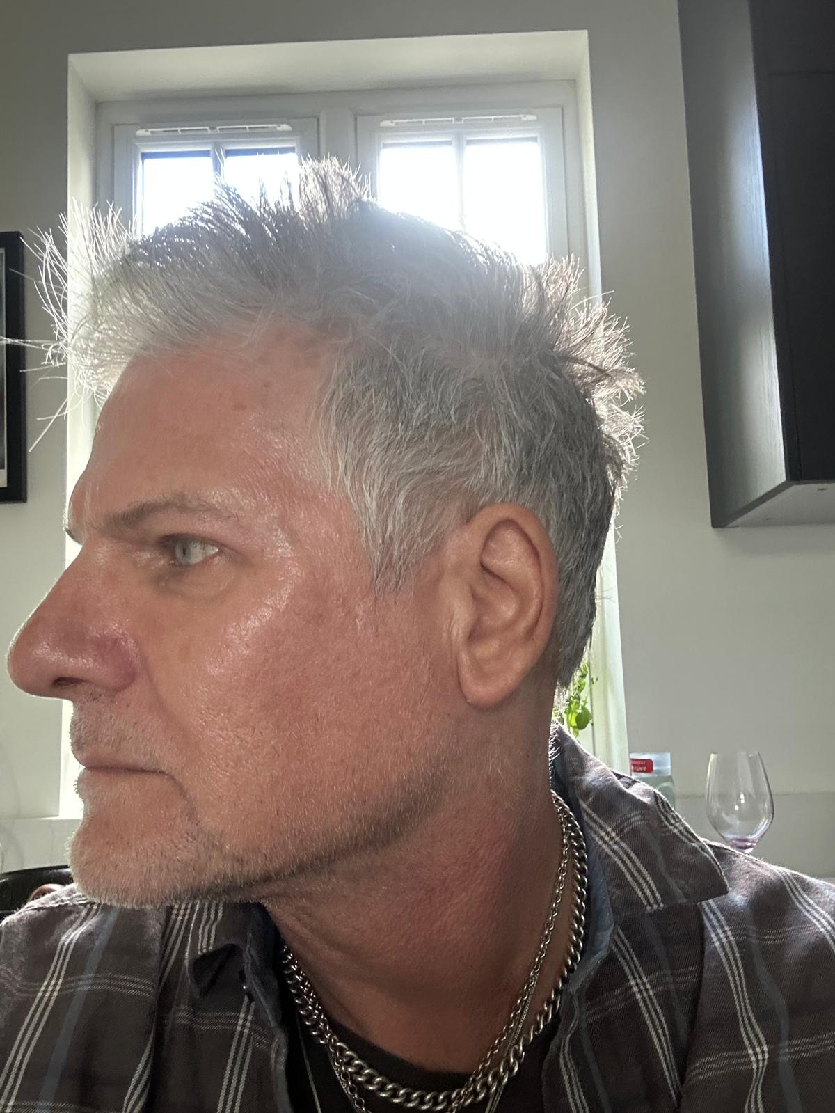 Origin Glass Laser Treatment 1 Day 1 recovery left view after full-face rejuvenation treatment.