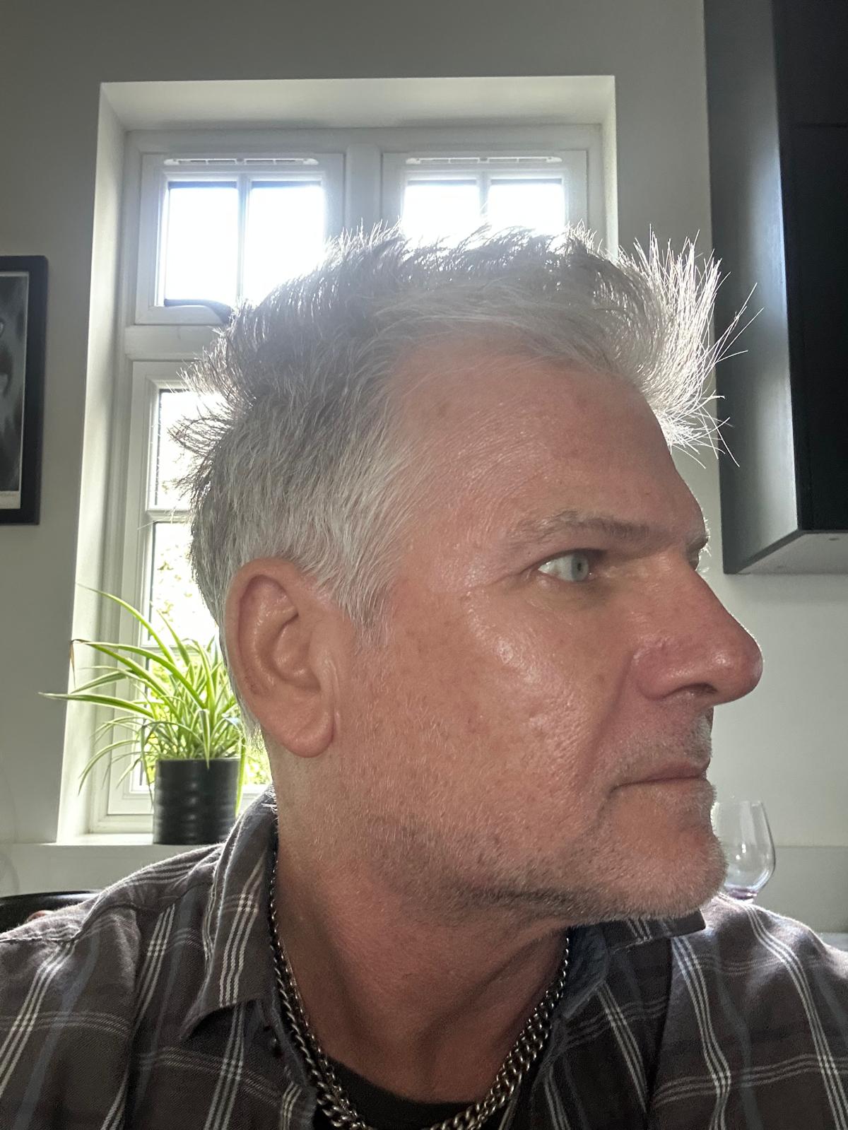 Origin Glass Laser Treatment 1 Day 1 recovery right view after full-face rejuvenation treatment.