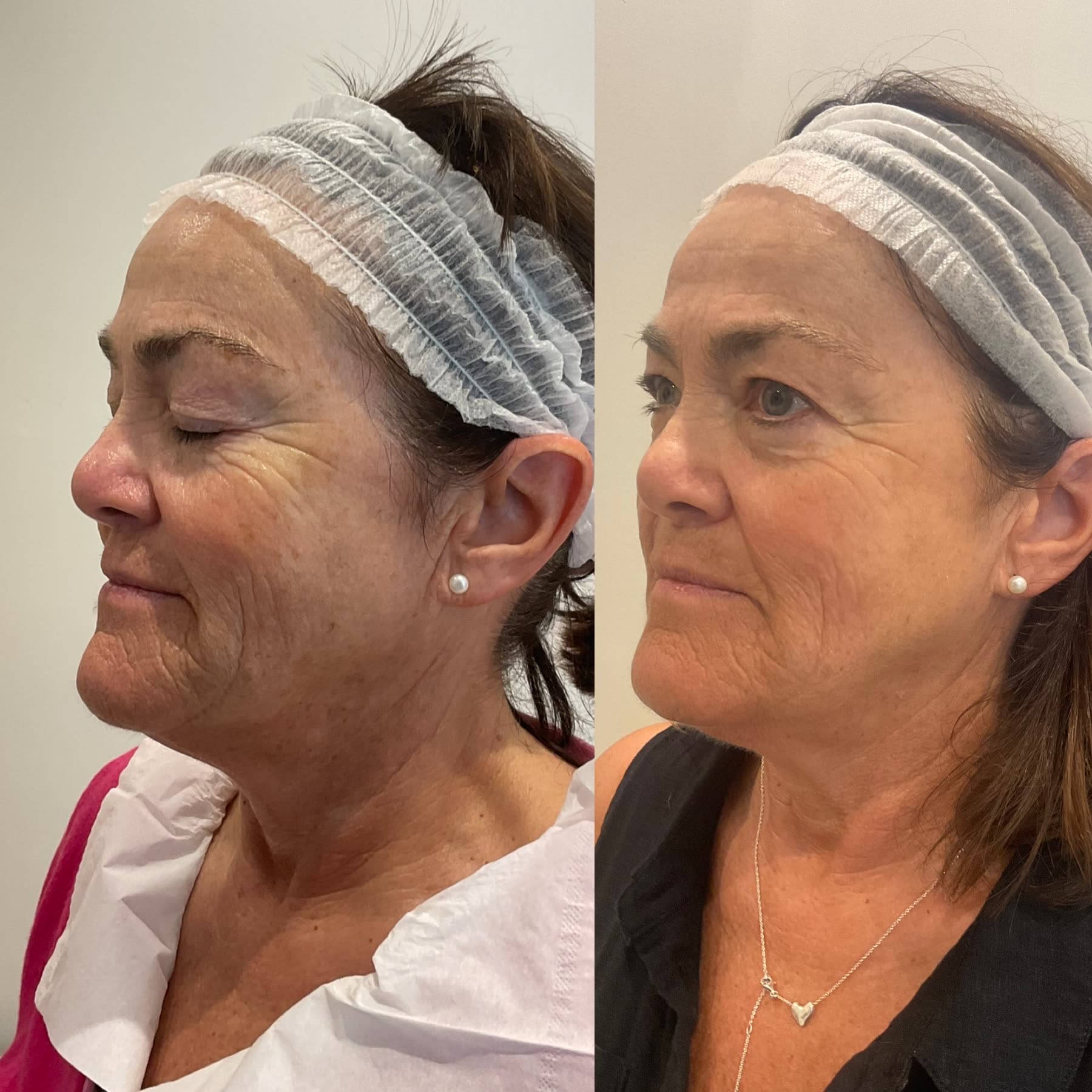 Origin Glass Laser texture and skin-quality before and after showing smoother-looking surface and refinement.