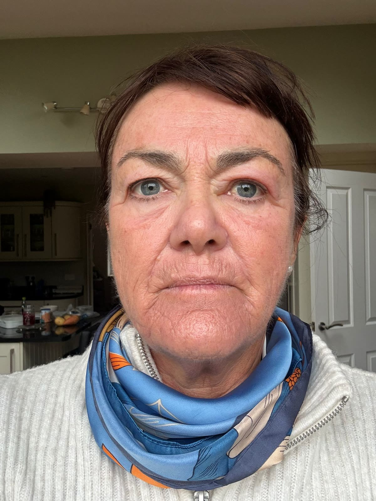Origin Glass Laser anonymous full recovery journey Treatment 1 Day 1 recovery photo 1, showing full face, around the eyes, jawline and neck.