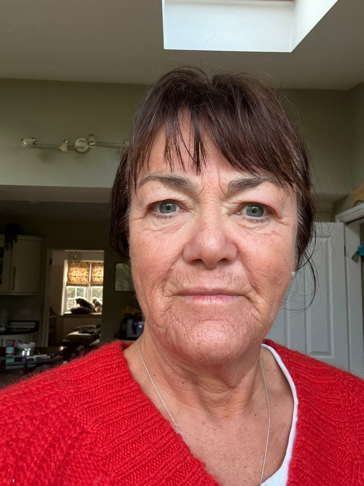 Origin Glass Laser anonymous full recovery journey Treatment 1 Day 2 recovery photo 1, showing full face, around the eyes, jawline and neck.