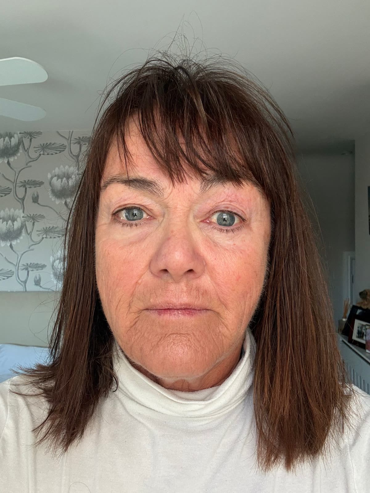 Origin Glass Laser anonymous full recovery journey Treatment 1 Day 3 recovery photo 1, showing full face, around the eyes, jawline and neck.