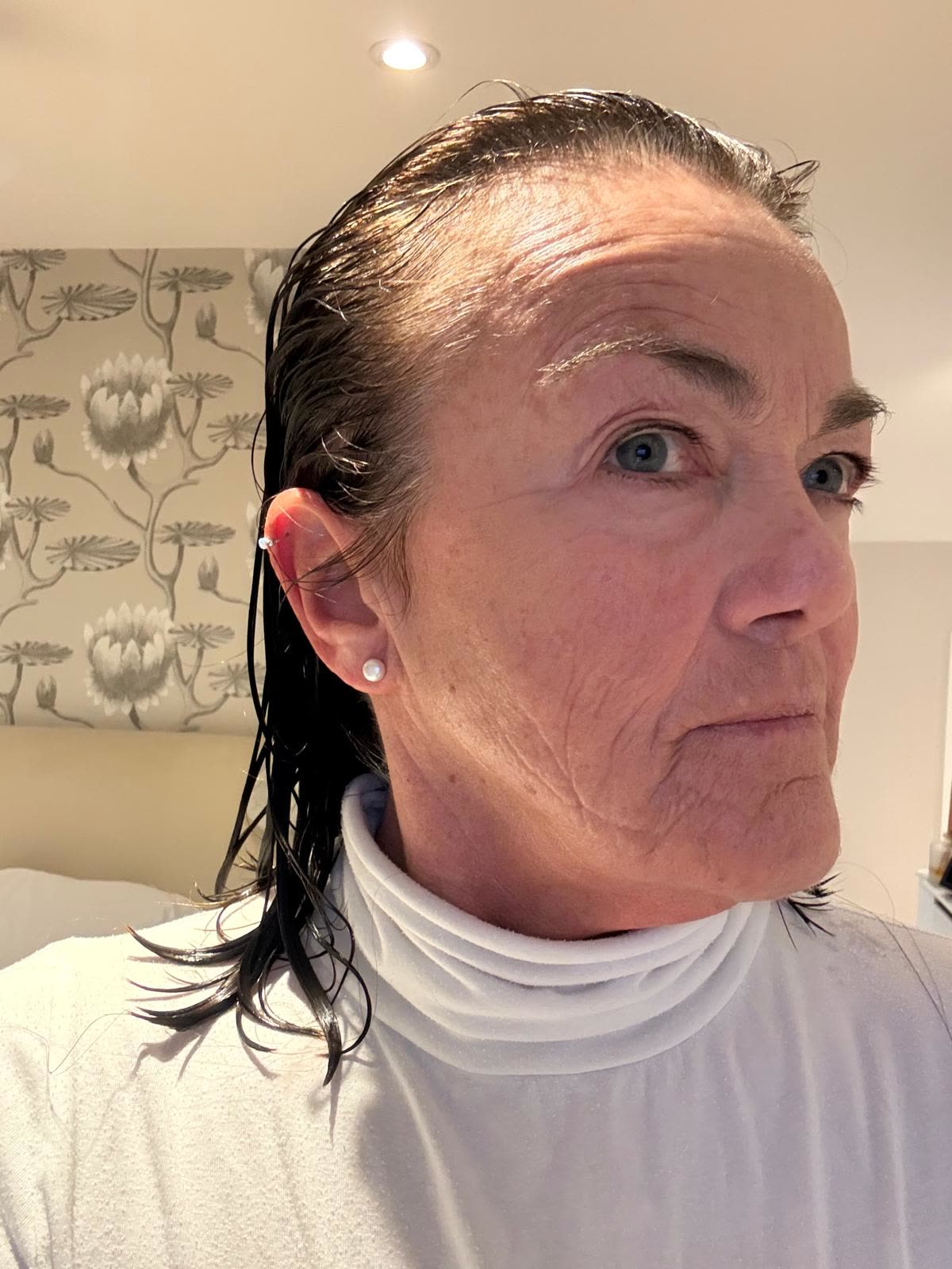 Origin Glass Laser anonymous full recovery journey Treatment 1 Day 6 recovery photo 1, showing full face, around the eyes, jawline and neck.