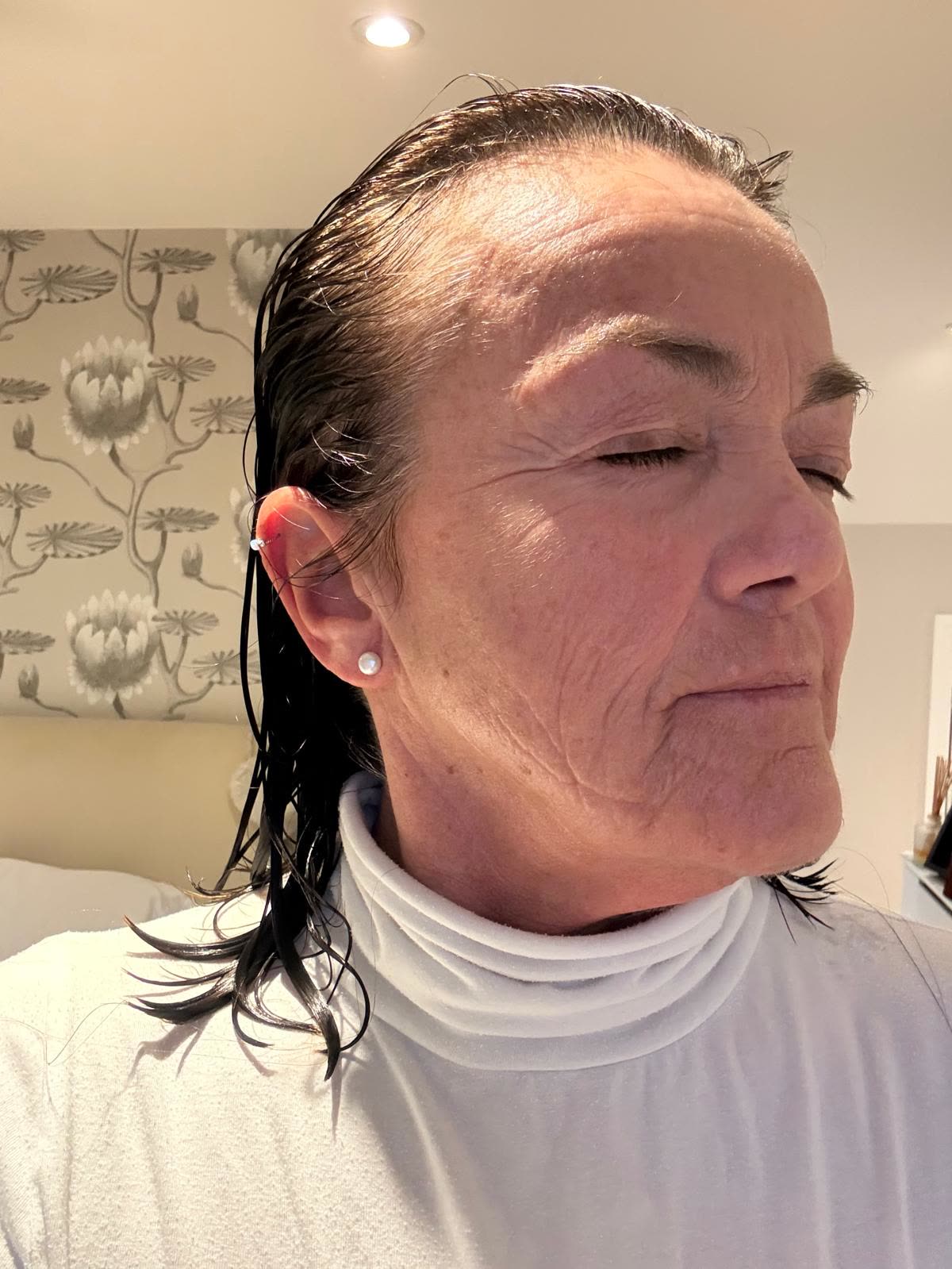 Origin Glass Laser anonymous full recovery journey Treatment 1 Day 6 recovery photo 2, showing full face, around the eyes, jawline and neck.