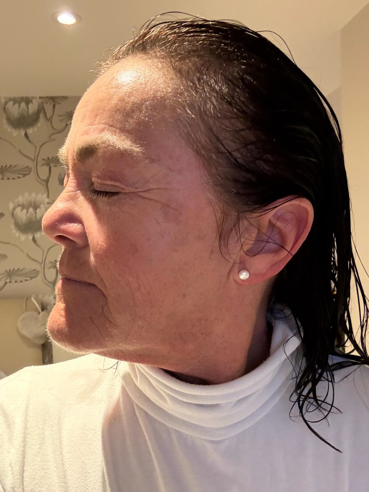 Origin Glass Laser anonymous full recovery journey Treatment 1 Day 6 recovery photo 3, showing full face, around the eyes, jawline and neck.