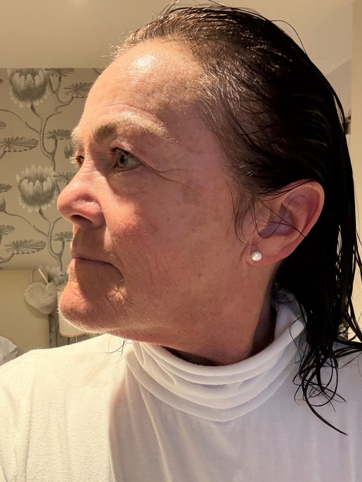Origin Glass Laser anonymous full recovery journey Treatment 1 Day 6 recovery photo 4, showing full face, around the eyes, jawline and neck.