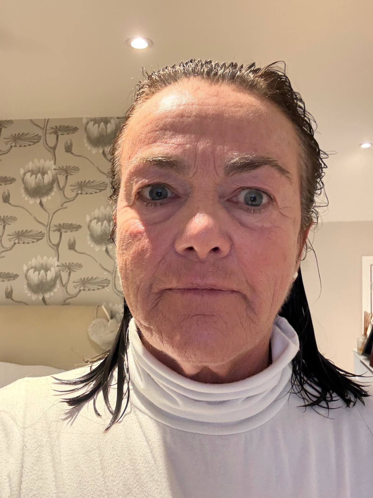 Origin Glass Laser anonymous full recovery journey Treatment 1 Day 6 recovery photo 5, showing full face, around the eyes, jawline and neck.