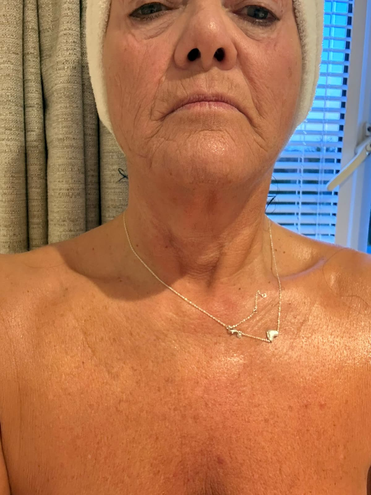 Origin Glass Laser anonymous full recovery journey Treatment 1 Day 6 recovery photo 6, showing full face, around the eyes, jawline and neck.