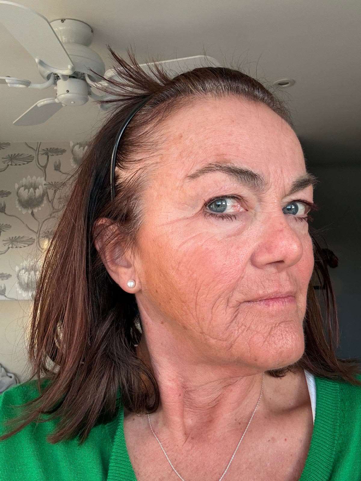 Origin Glass Laser anonymous full recovery journey Treatment 1 Day 7 recovery photo 1, showing full face, around the eyes, jawline and neck.