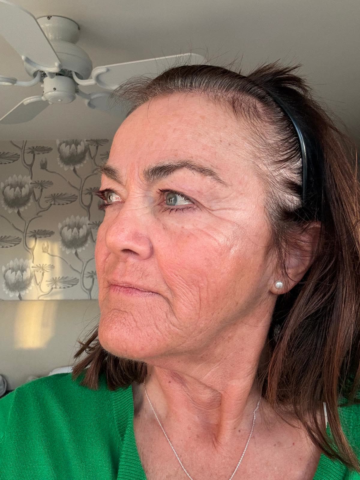 Origin Glass Laser anonymous full recovery journey Treatment 1 Day 7 recovery photo 2, showing full face, around the eyes, jawline and neck.