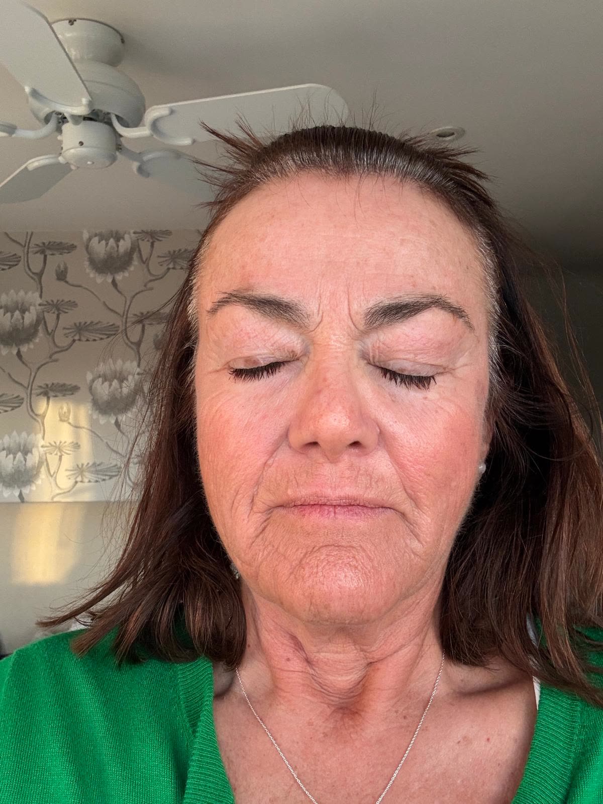 Origin Glass Laser anonymous full recovery journey Treatment 1 Day 7 recovery photo 3, showing full face, around the eyes, jawline and neck.