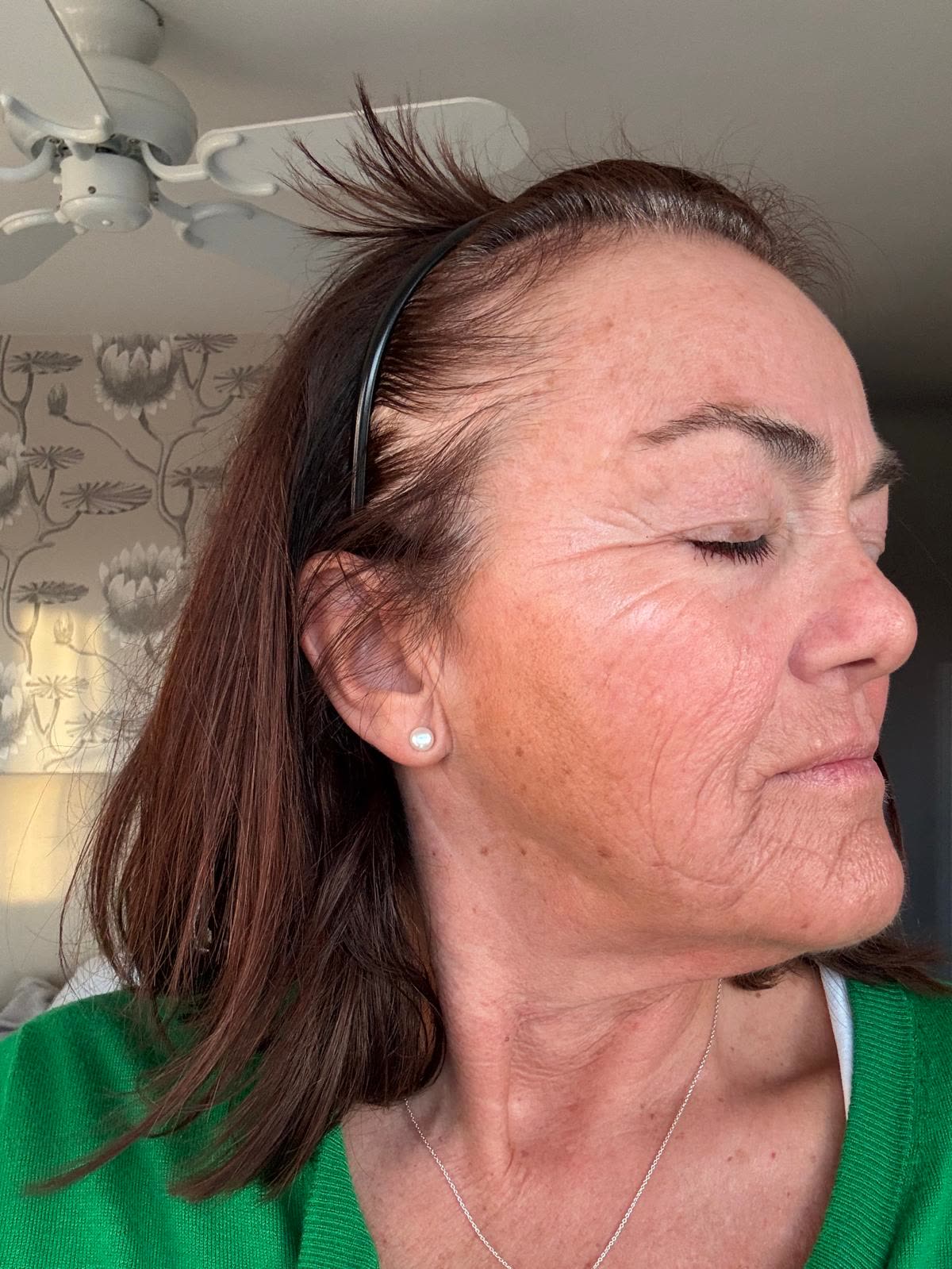 Origin Glass Laser anonymous full recovery journey Treatment 1 Day 7 recovery photo 4, showing full face, around the eyes, jawline and neck.