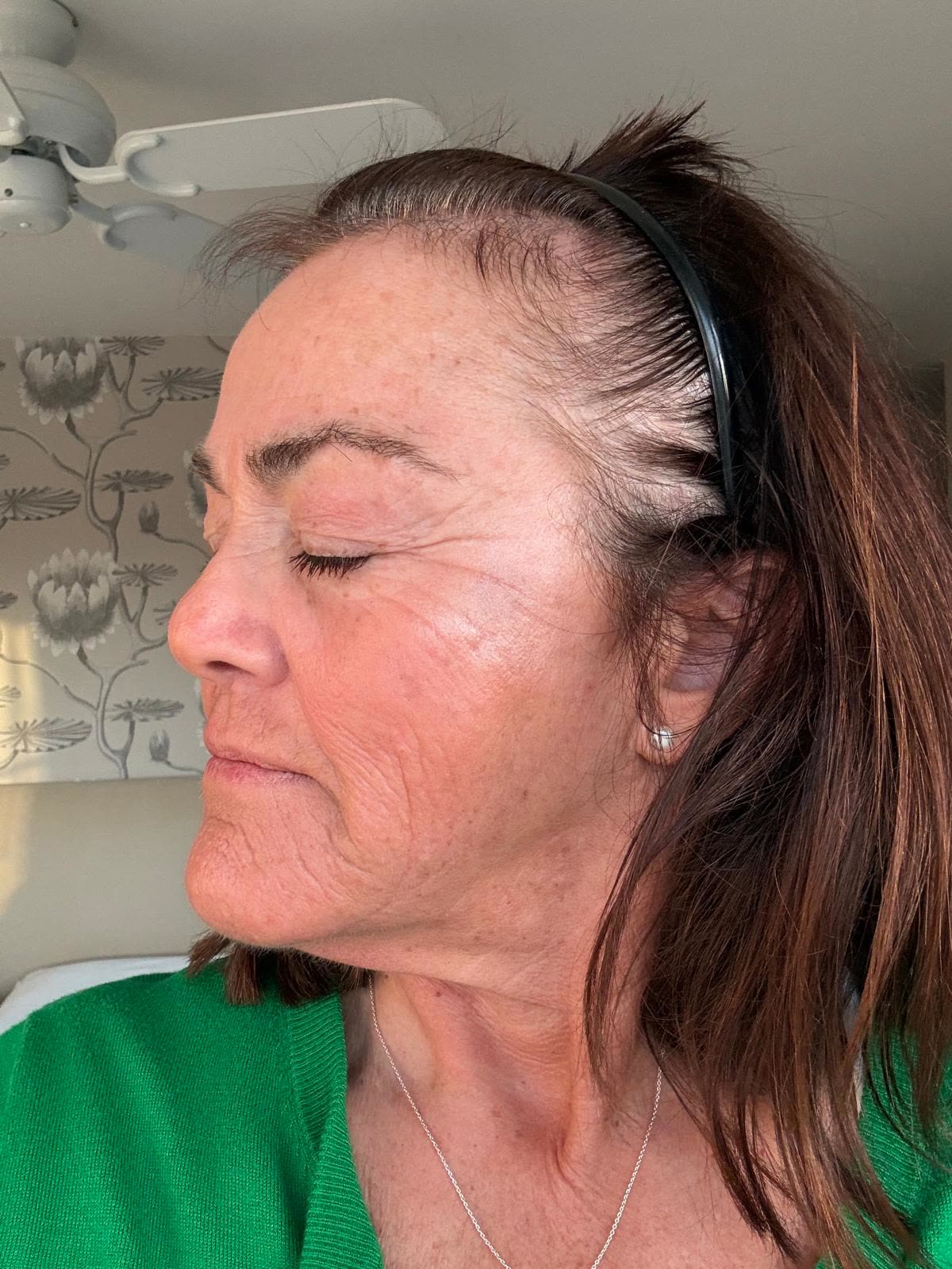 Origin Glass Laser anonymous full recovery journey Treatment 1 Day 7 recovery photo 5, showing full face, around the eyes, jawline and neck.