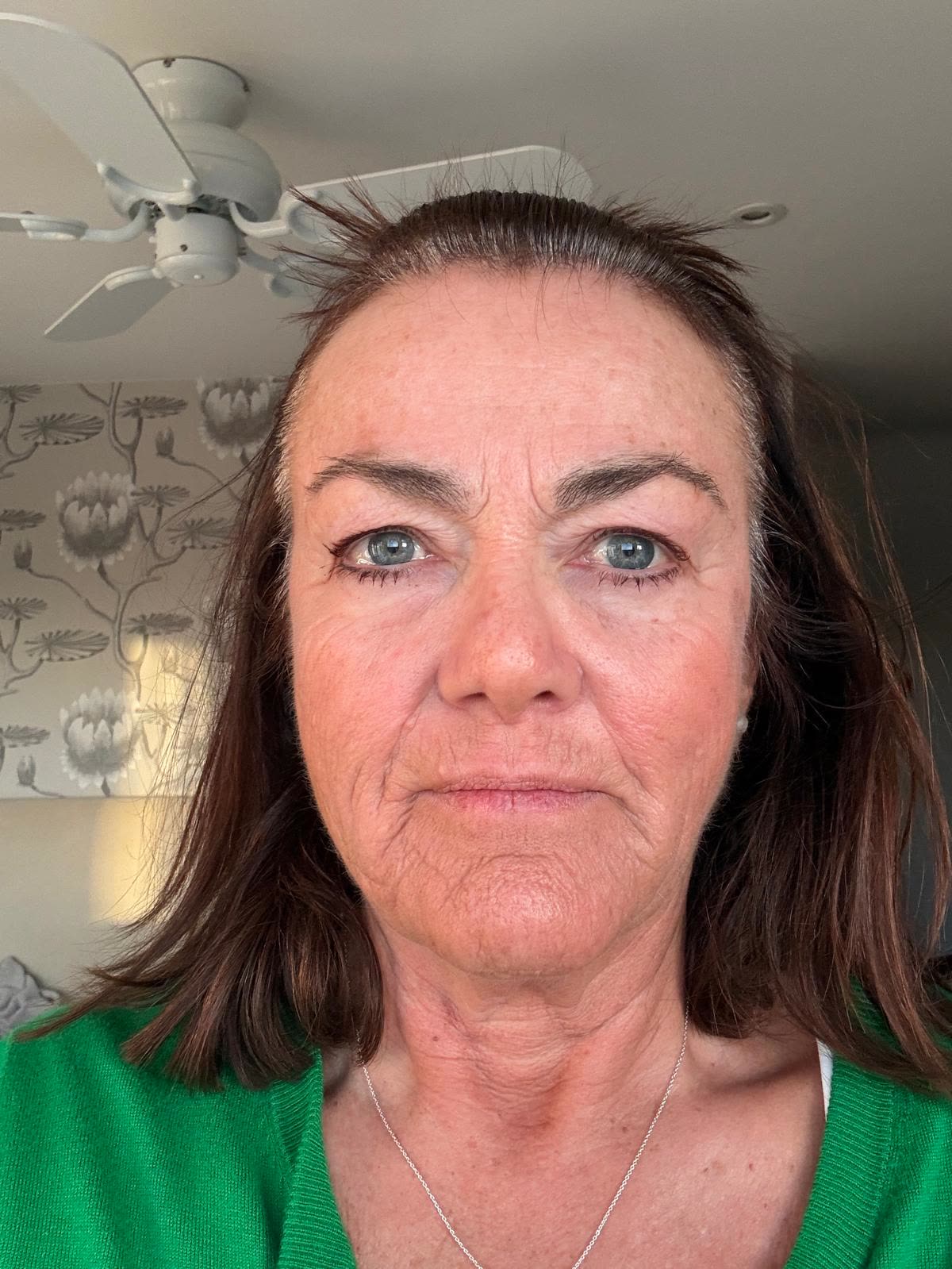 Origin Glass Laser anonymous full recovery journey Treatment 1 Day 7 recovery photo 6, showing full face, around the eyes, jawline and neck.