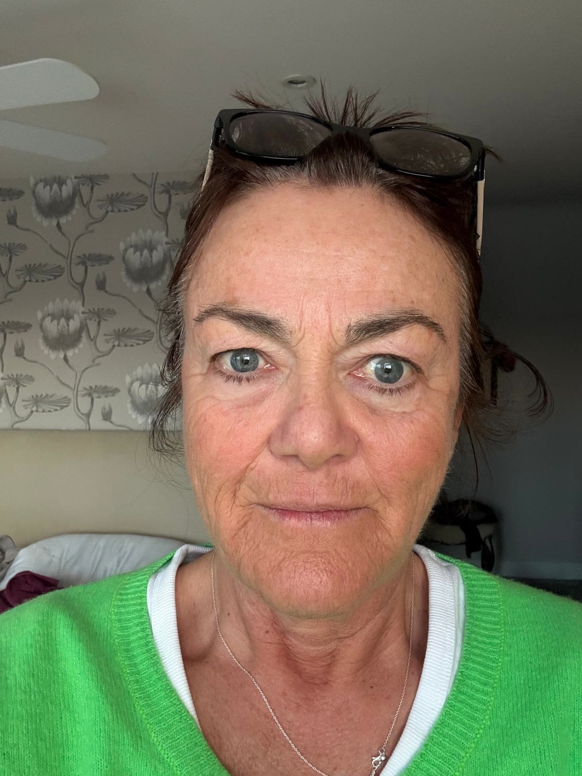 Origin Glass Laser anonymous full recovery journey Treatment 1 Day 8 recovery photo 1, showing full face, around the eyes, jawline and neck.