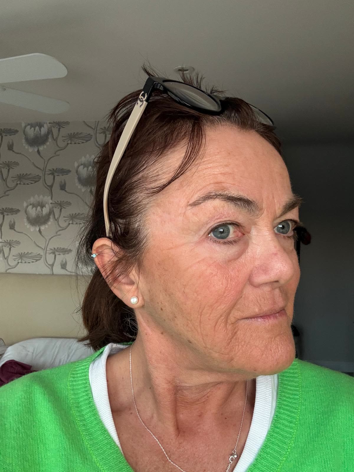 Origin Glass Laser anonymous full recovery journey Treatment 1 Day 8 recovery photo 2, showing full face, around the eyes, jawline and neck.