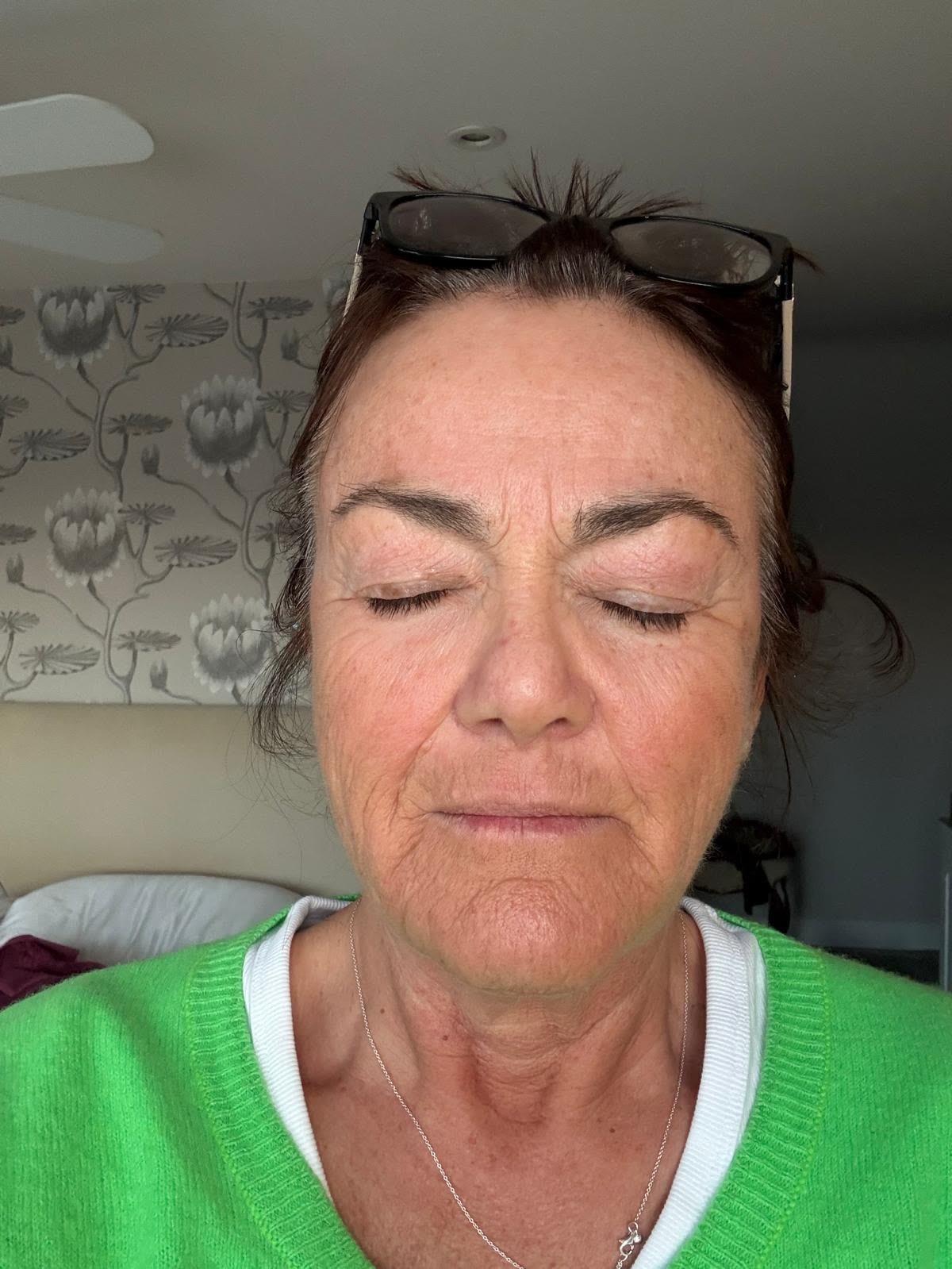 Origin Glass Laser anonymous full recovery journey Treatment 1 Day 8 recovery photo 3, showing full face, around the eyes, jawline and neck.