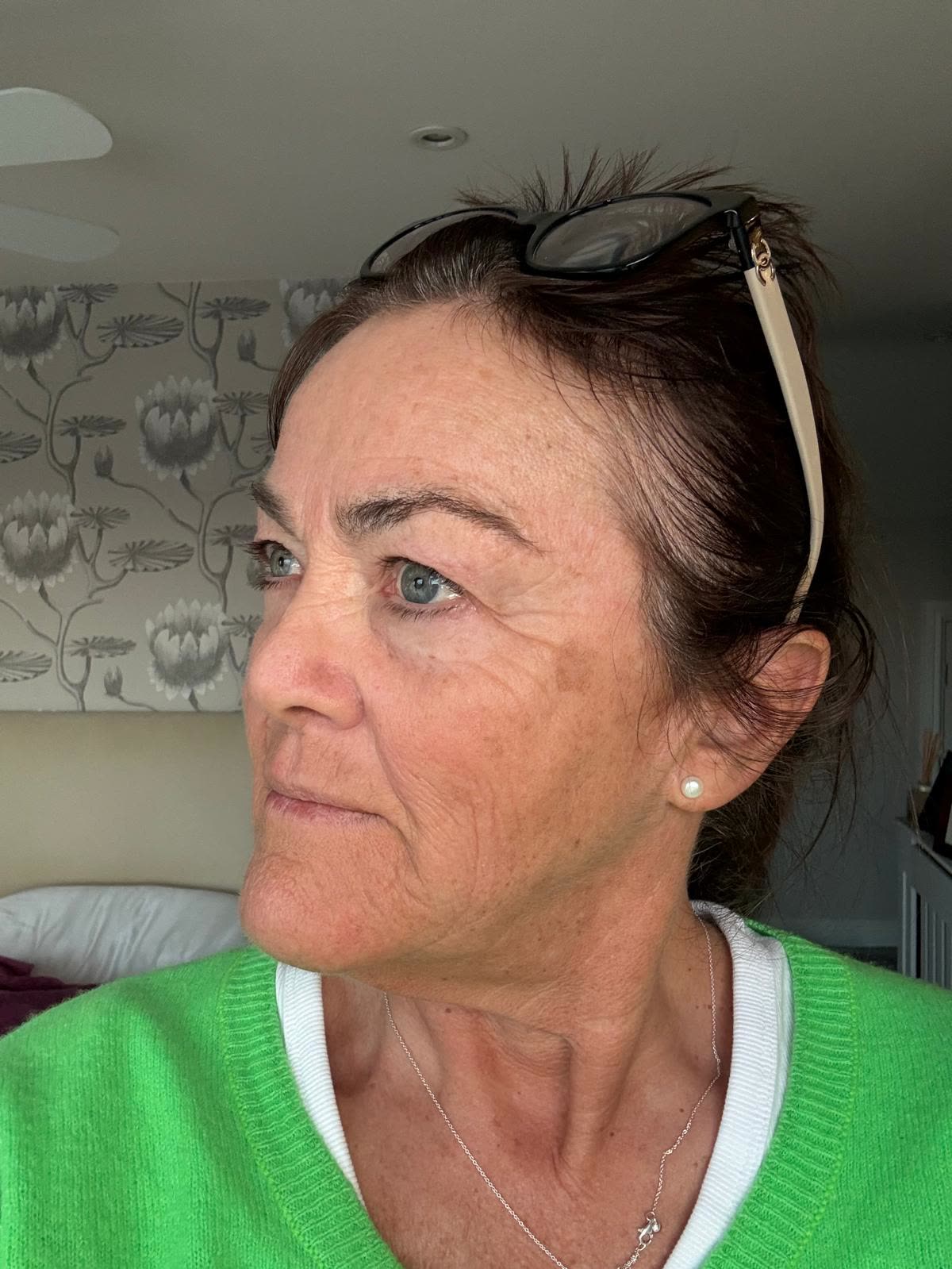 Origin Glass Laser anonymous full recovery journey Treatment 1 Day 8 recovery photo 4, showing full face, around the eyes, jawline and neck.
