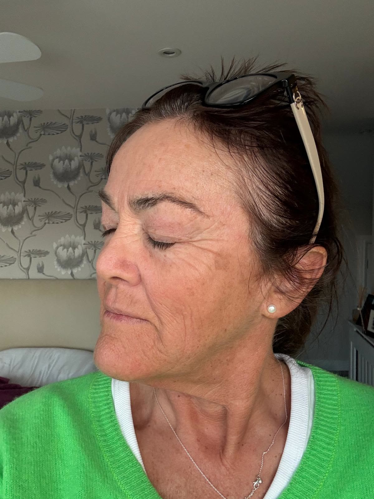 Origin Glass Laser anonymous full recovery journey Treatment 1 Day 8 recovery photo 5, showing full face, around the eyes, jawline and neck.