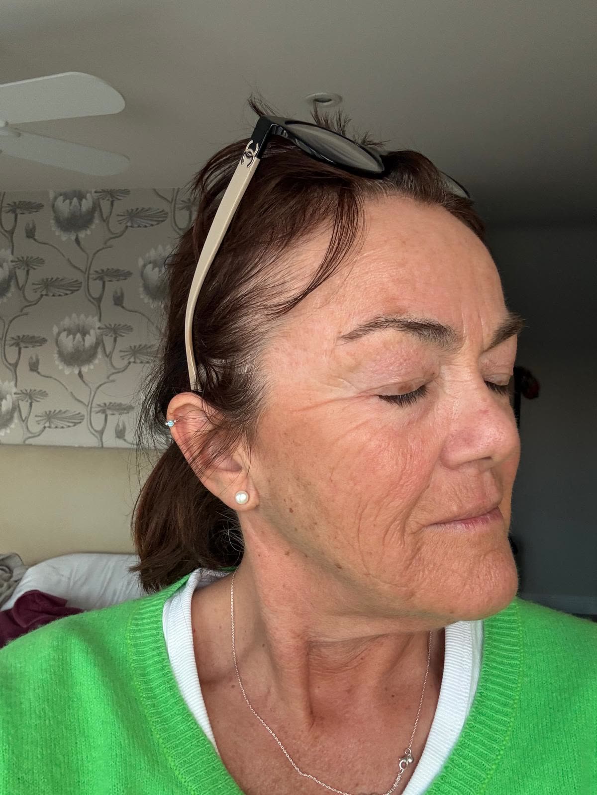 Origin Glass Laser anonymous full recovery journey Treatment 1 Day 8 recovery photo 6, showing full face, around the eyes, jawline and neck.