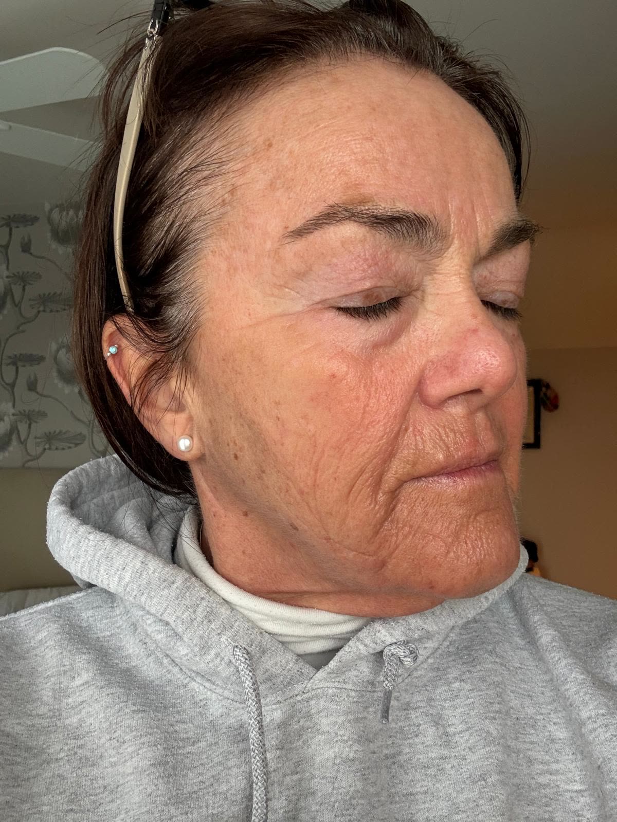 Origin Glass Laser anonymous full recovery journey Treatment 1 Day 10 recovery photo 2, showing full face, around the eyes, jawline and neck.