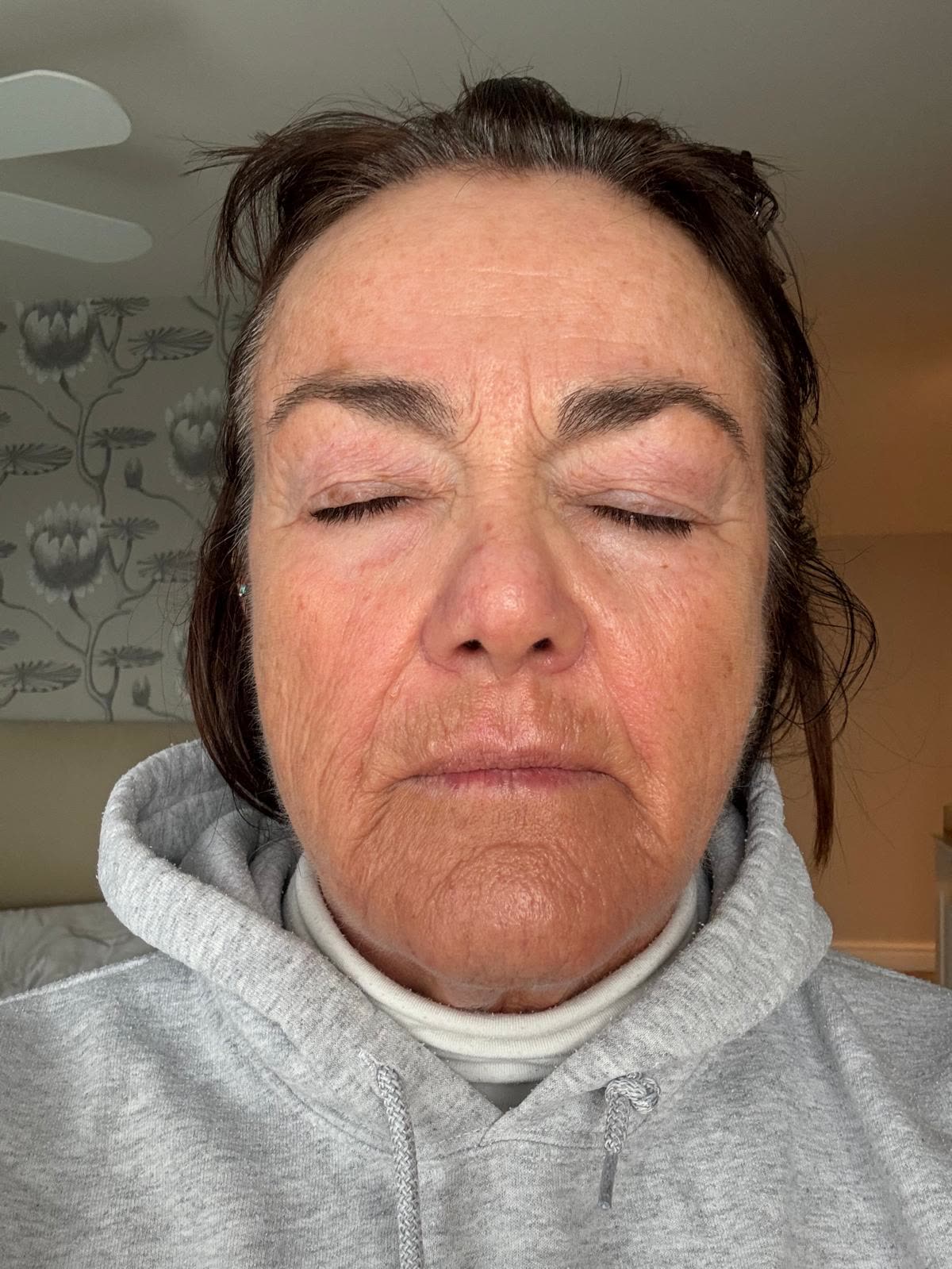 Origin Glass Laser anonymous full recovery journey Treatment 1 Day 10 recovery photo 3, showing full face, around the eyes, jawline and neck.