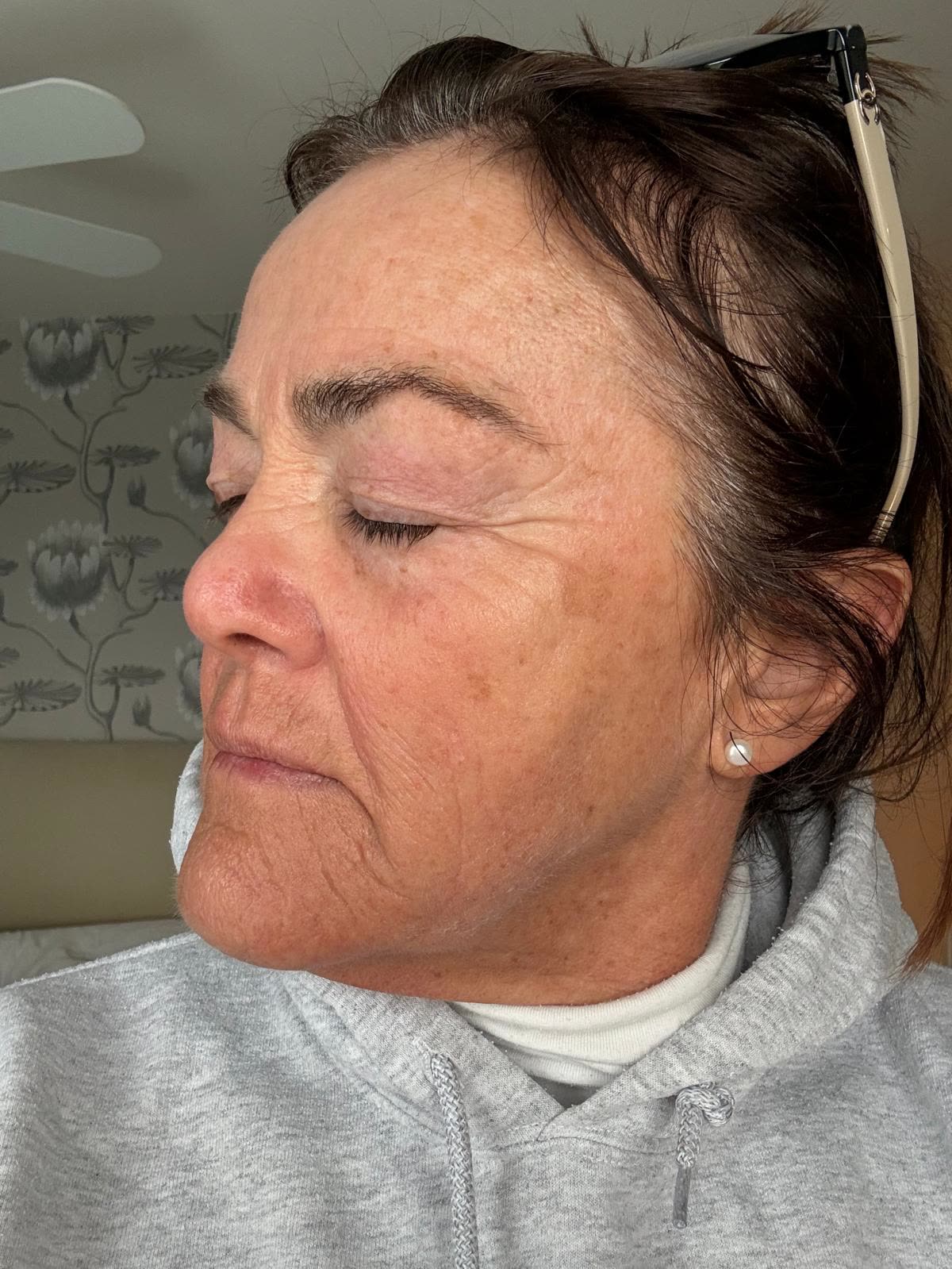 Origin Glass Laser anonymous full recovery journey Treatment 1 Day 10 recovery photo 4, showing full face, around the eyes, jawline and neck.