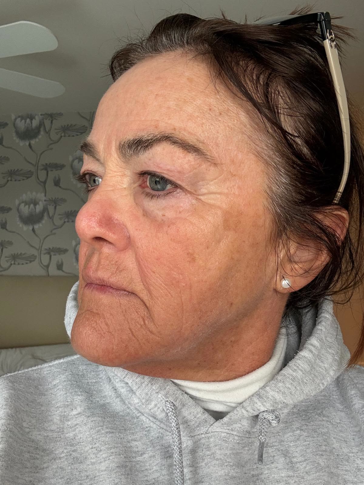 Origin Glass Laser anonymous full recovery journey Treatment 1 Day 10 recovery photo 5, showing full face, around the eyes, jawline and neck.