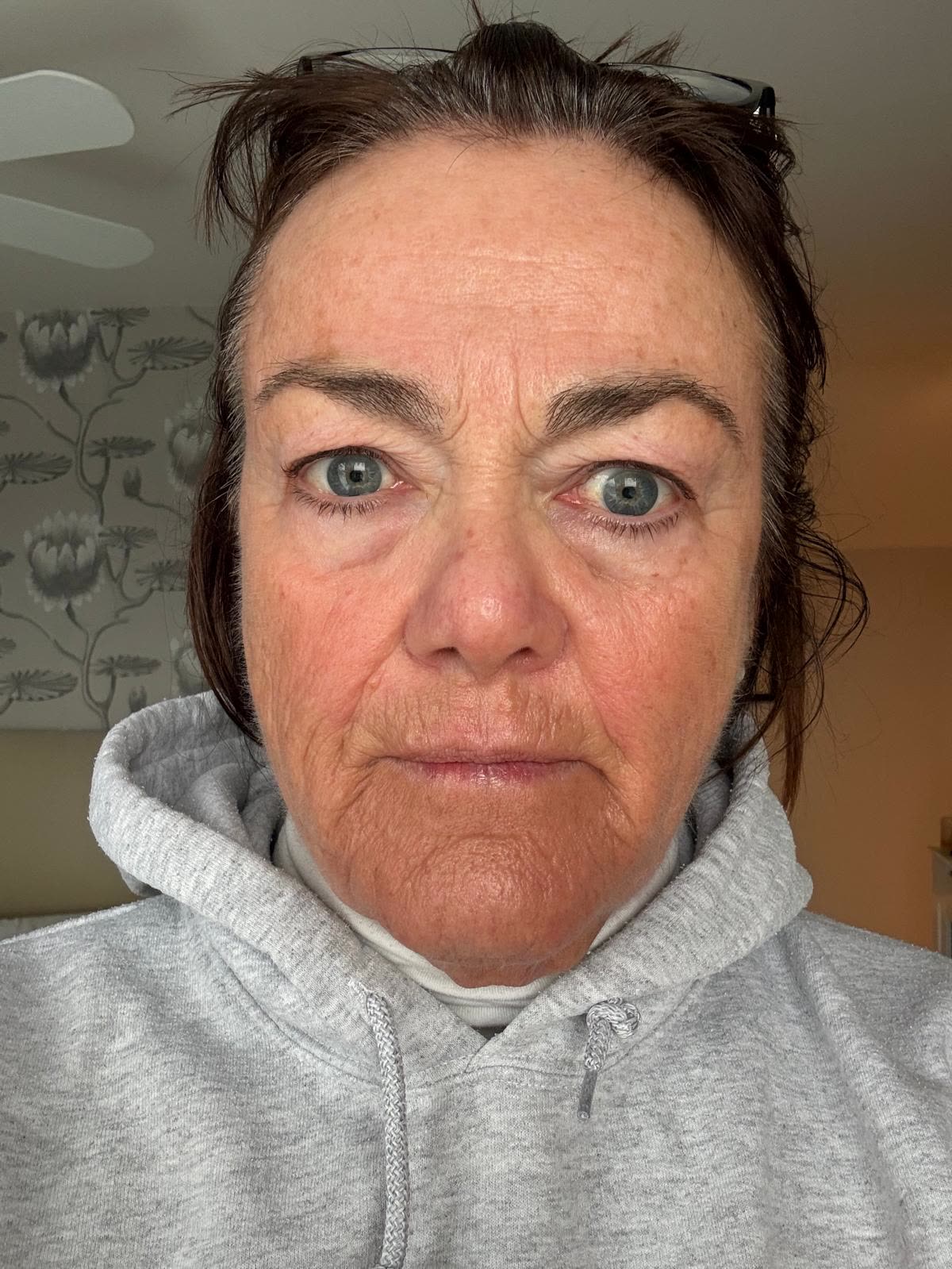Origin Glass Laser anonymous full recovery journey Treatment 1 Day 10 recovery photo 6, showing full face, around the eyes, jawline and neck.