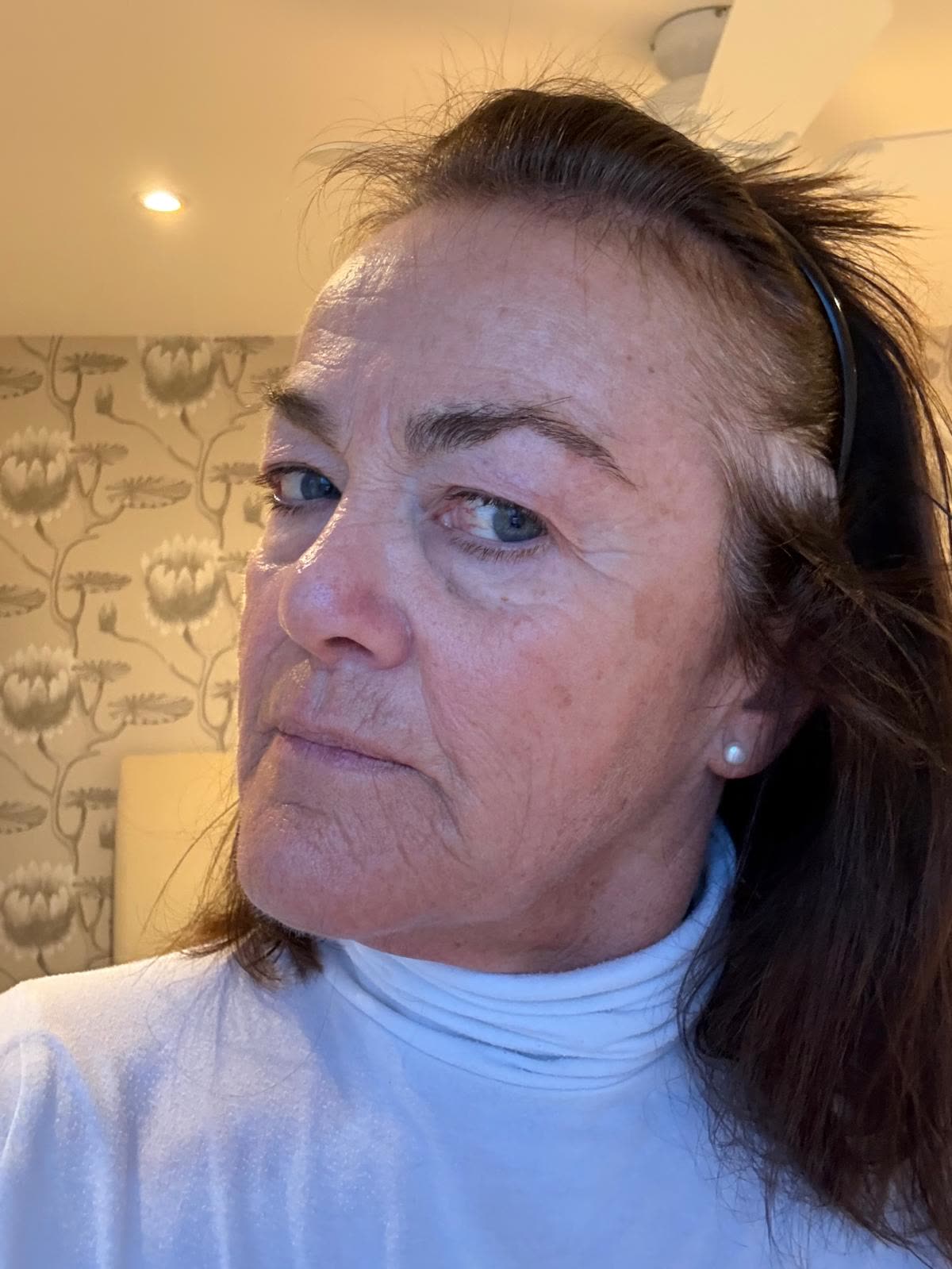 Origin Glass Laser anonymous full recovery journey Treatment 1 Day 13 recovery photo 1, showing full face, around the eyes, jawline and neck.