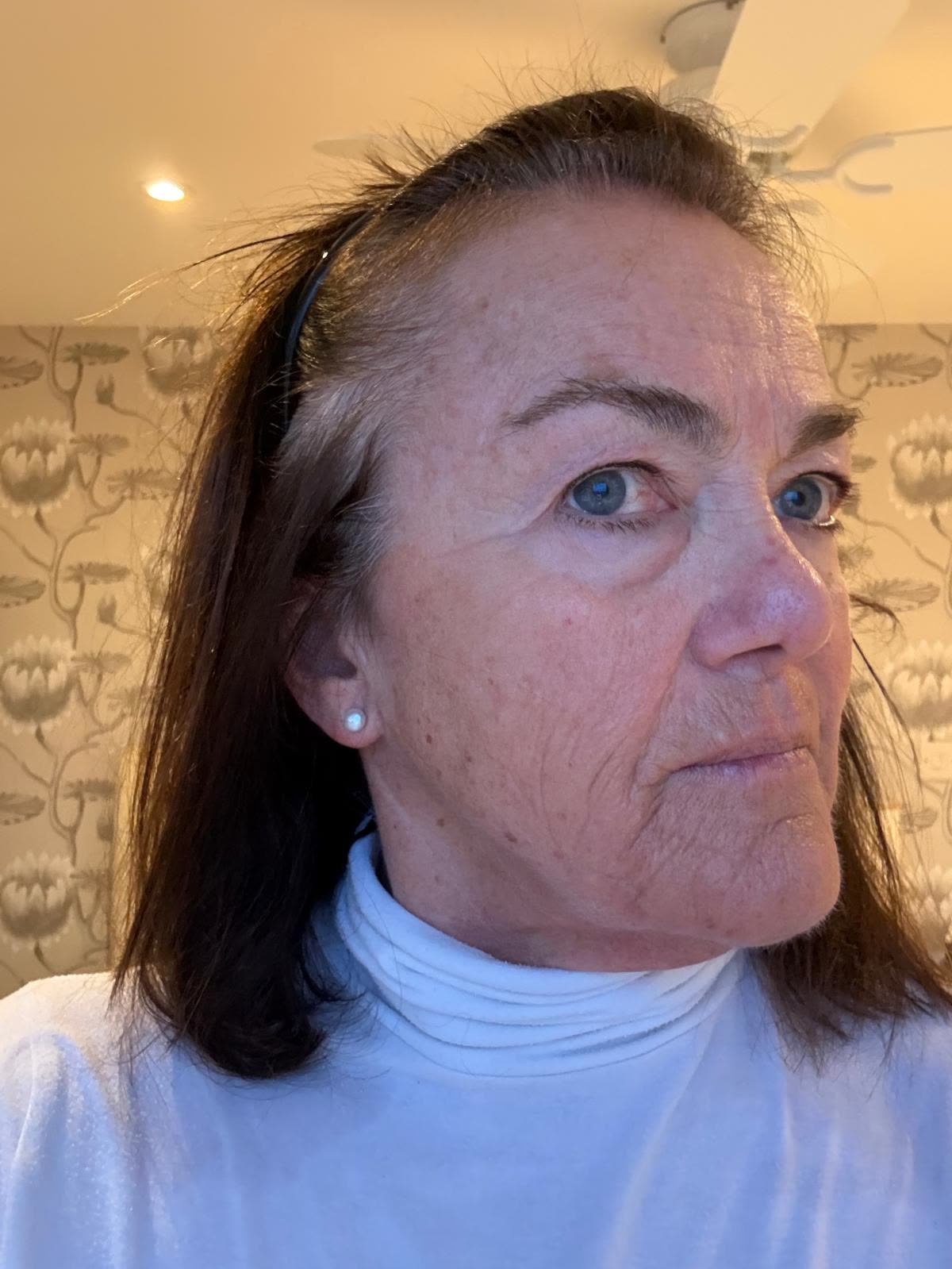 Origin Glass Laser anonymous full recovery journey Treatment 1 Day 13 recovery photo 2, showing full face, around the eyes, jawline and neck.