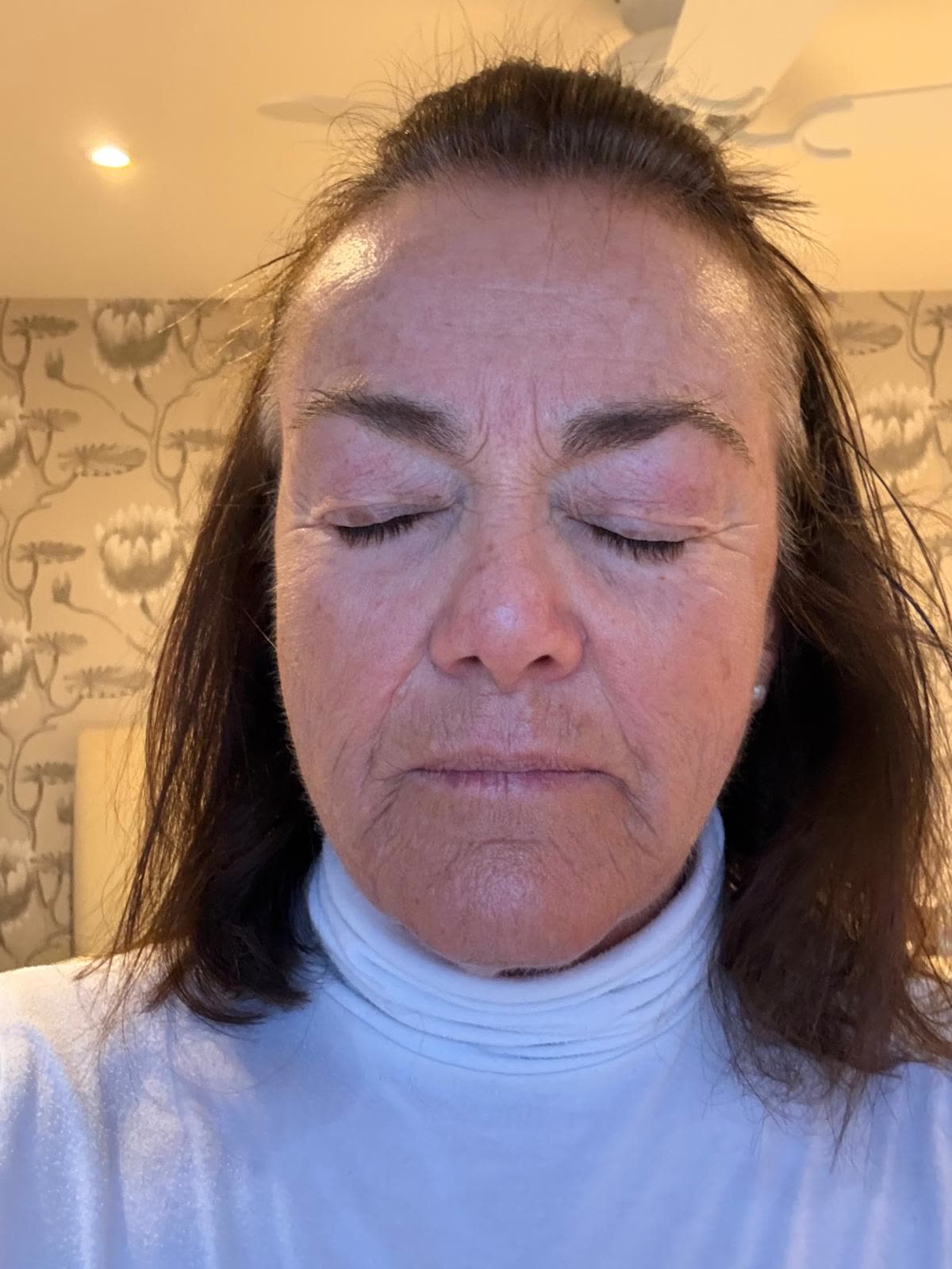Origin Glass Laser anonymous full recovery journey Treatment 1 Day 13 recovery photo 3, showing full face, around the eyes, jawline and neck.